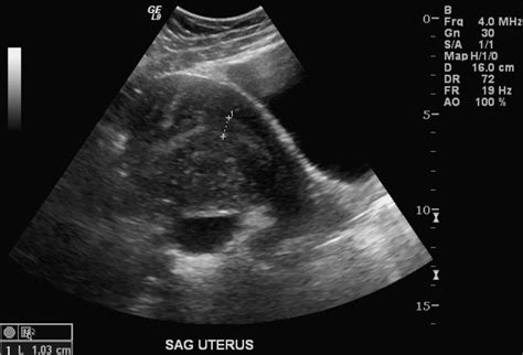 Adenomyosis - wikidoc