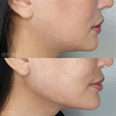 Non Surgical Jawline Sculpting Contouring In Jawline Cosmetic