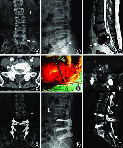 Representative Case 2 A 56 Year Old Female Patient With Typical