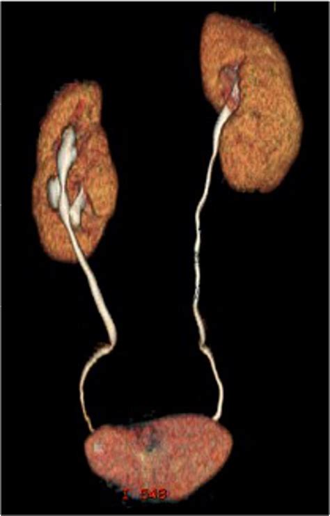 Volume Rendering Reconstruction Of Ct Scan In 49 Year Old Woman Showing