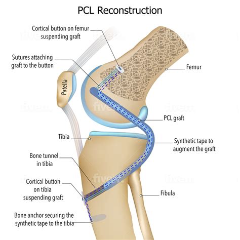 PCL Reconstruction | Posterior Cruciate Ligament