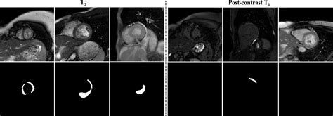 Automated Myocardial T2 And Extracellular Volume Quantification In