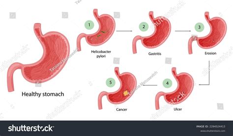 Stomach Diseases Diagram Of Diseases Of Royalty Free Stock Vector