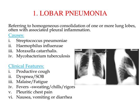 Ppt Pneumonia Radiology Powerpoint Presentation Free Download Id