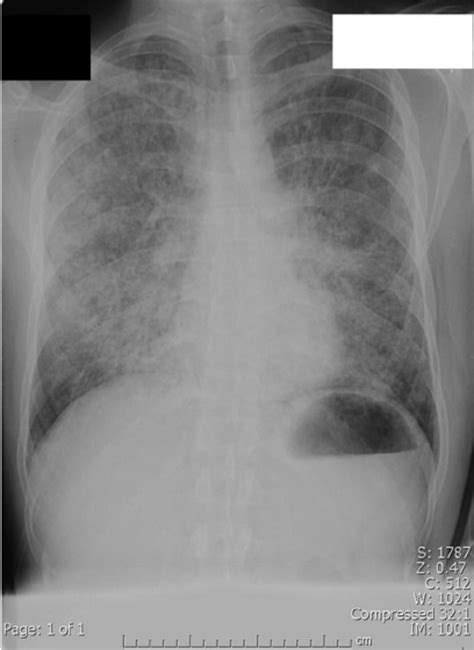 Chest Radiograph From An Hiv Infected Patient With Pneumocystis Download Scientific Diagram