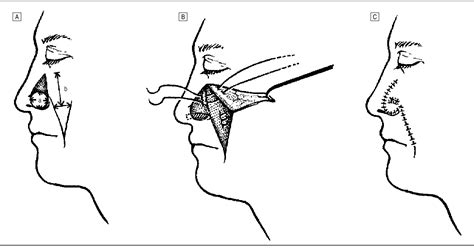 Figure 1 from Reliability of the melolabial flap for alar ...