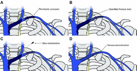 Schematic Illustration Of Transcervical Retrograde Thoracic Duct Glue Download Scientific