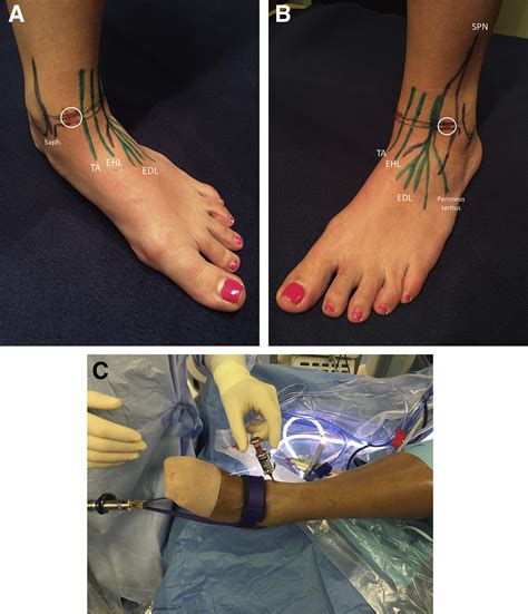 Ankle Arthroscopy With Microfracture For Osteochondral Defects Of The Talus Arthroscopy Techniques