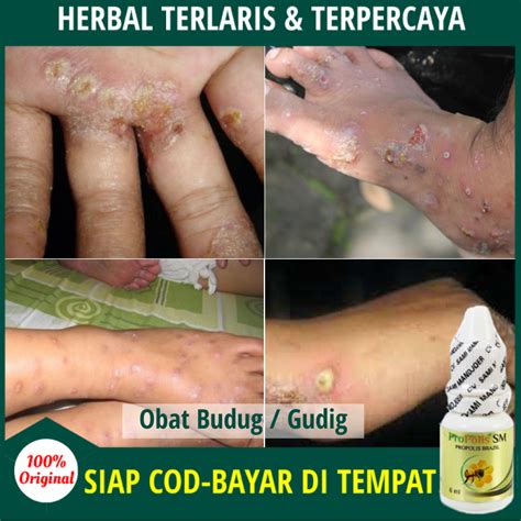 Obat Budug Alami Penghilang Bekas Budug Di Tangan Kaki And Tubuh Lainya