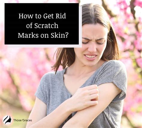 How to Get Rid of Scratch Marks on Skin [9 Effective Methods] - ThoseGraces.com