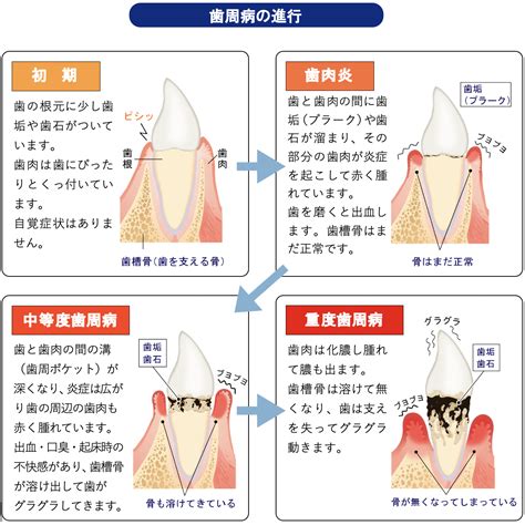 歯周病の進行と症状 京大病院近くの歯医者｜聖護院やぎ歯科・矯正歯科｜京大病院・神宮丸太町駅