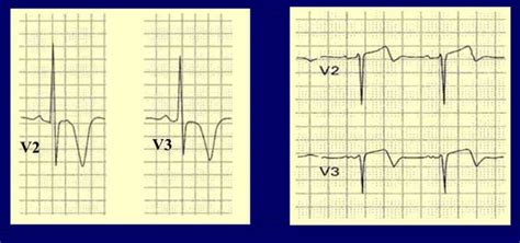 a) Inverted T-wave, b) biphasic T-wave | Download Scientific Diagram