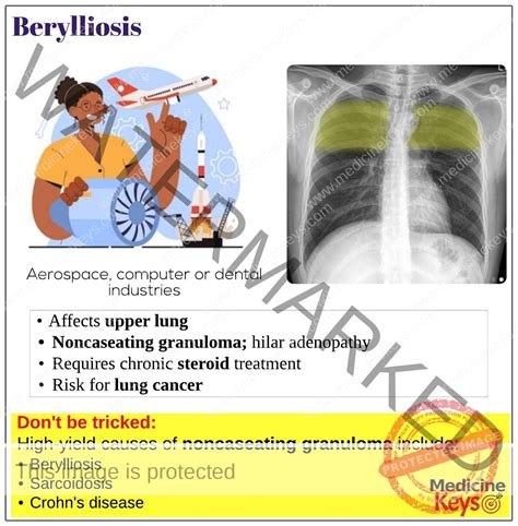 Berylliosis - Medicine Keys for MRCPs