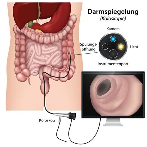 Chronisch Entz Ndliche Darmerkrankungen Infos Kliniken