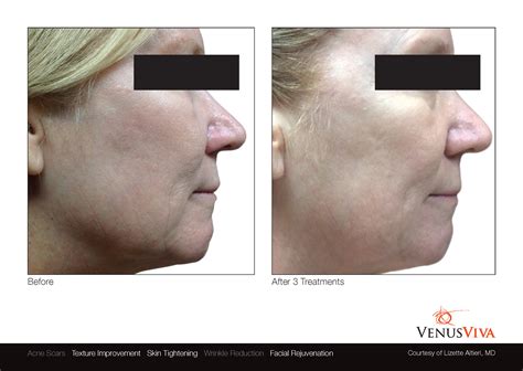 Skin Resurfacing Austin | Venus Viva | Simple Radiance Medspa