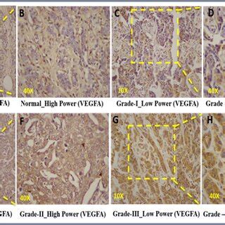 Increased Cell Proliferative Migratory Invasive And EMT Capacities