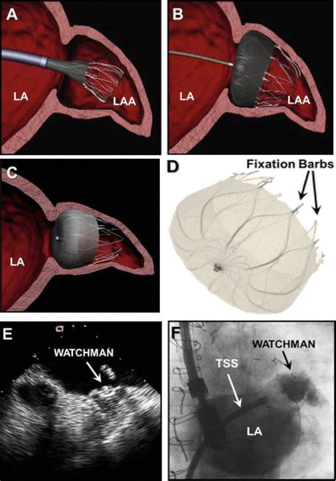 Percutaneous Left Atrial Appendage Occlusion For Stroke Prevention In