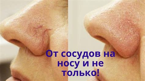 Без операции! Как убрать сосуды на носу и не только. Своими руками ...