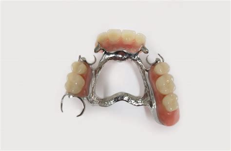 Metal Partial Dentures Wantirna, Boronia, Bayswater, Heathmont & Scoresby