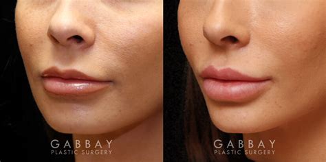 Lip Augmentation Before And After