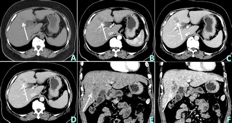 Figure 1 From A Hepatic Sparganosis Misdiagnosed As Intrahepatic Mass