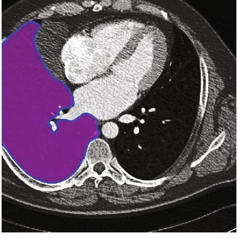 Final segmentation of the region of interest; the region's boundary ... 