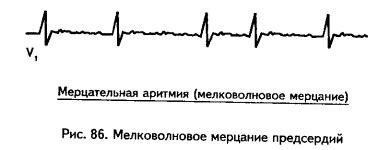 VI.4.2. Мерцание желудочков