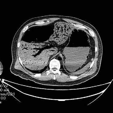 Postmortem Computed Tomography Reveals Extensive Dilatation Of