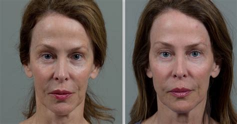 Vampire Facelift In Birmingham Al Seiler Skin