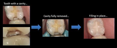 Cavity Before And After