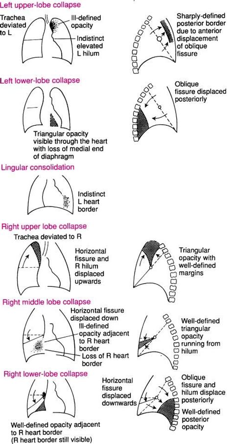 Chest X Ray Systematic Approach Doctor Uk Medical