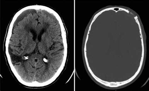 Surgical Neurology International