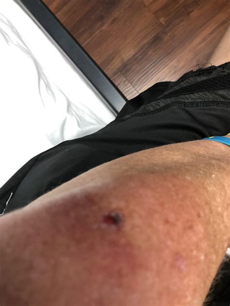 Once Bitten Twice As Shy Babe Was Bitten By Brown Recluse Over The Weekend Ugh R Spiderbites