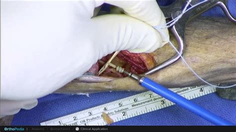 Thumb Cmc Arthritis Apl Suspensionplasty Using An Internalbrace