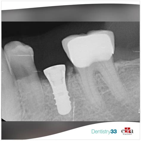 Why And How To Convince Patients Of The Importance Of Replacing Lost Or