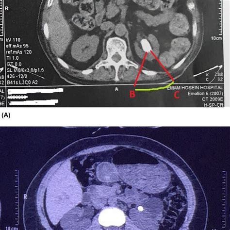 Illustration Of Retrorenal Colon In Cross Sectional Imaging Of Two