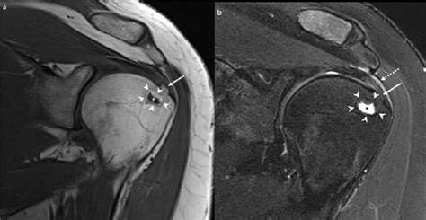 A 36 Year Old Female With Calcific Tendinopathy Of The Left Rotator