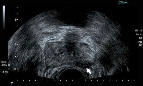 Contrast Enhanced Versus Systematic Transrectal Ultrasound Guided