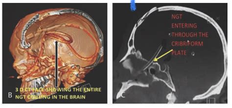 Oren Gottfried Md On Twitter Please Never Place A Nasogastric Tube