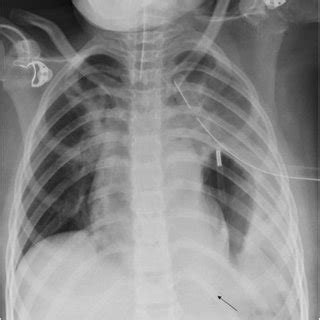 Arrow Showing The Tip Of The Nasogastric Ng Tube Positioned In The