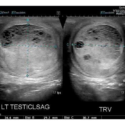 Scrotal Anatomy Ultrasound