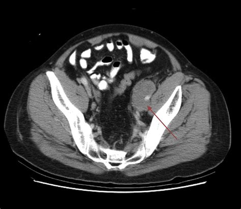 Enlarged lymph node in the left external iliac region encompassing the ...