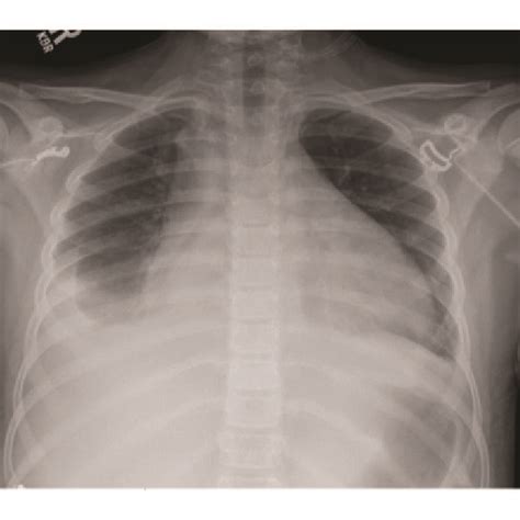 A Admission Chest X Ray Demonstrating Enlarged Cardiac Silhouette