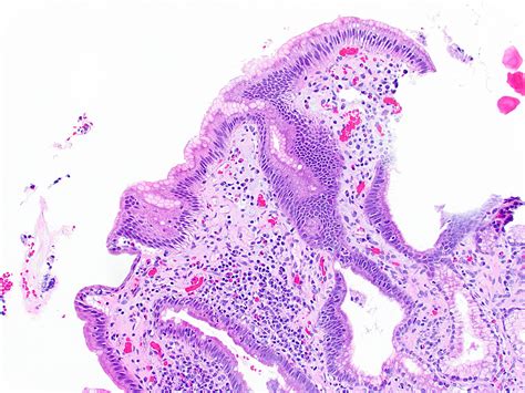 Duodenal Ulcer Histology