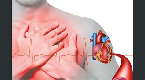 Infarto Del Miocardio Tratamientos Modernos La Prensa Gráfica