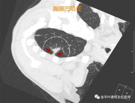 15个常见的恶性肺结节影像特征 建议收藏 肺癌 病灶 胸膜 新浪新闻