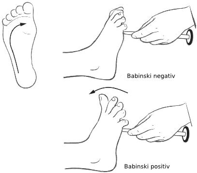 medical student: Babinski sign