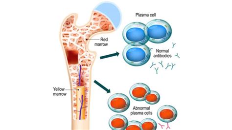 Multiple Myeloma Treatment - Sutured