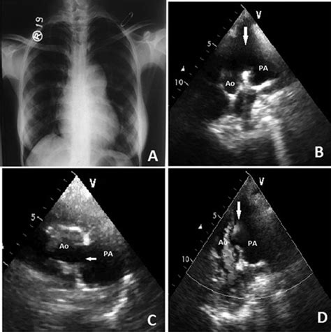 Aortopulmonary Window And Interrupted Aortic Arch With Eisenmenger