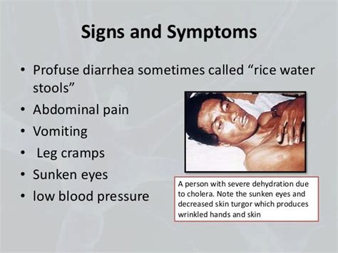 Cholera disease